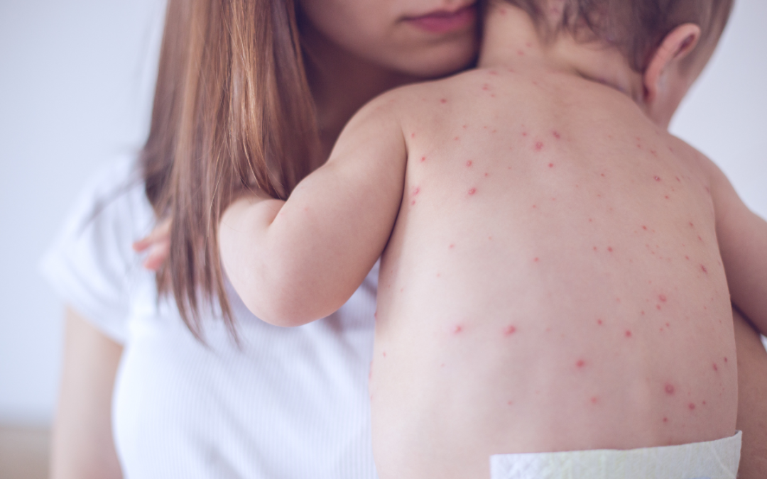Everything Parents Need to Know About the 2025 Measles Outbreak